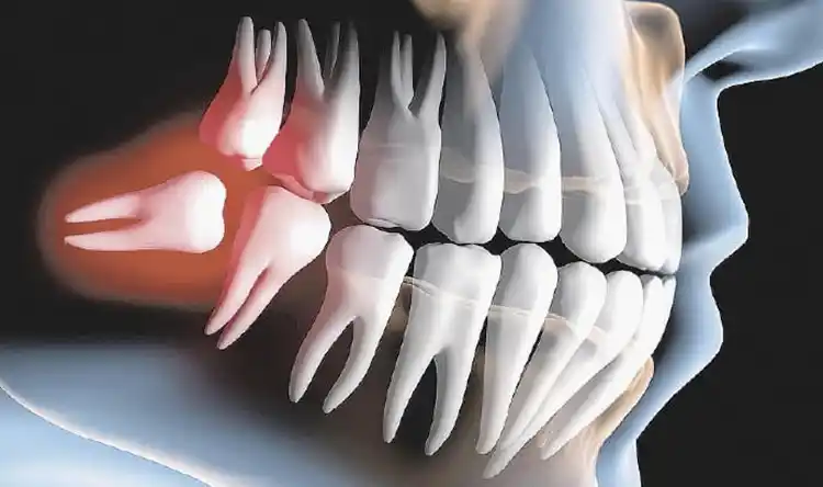 Cirurgia de Siso