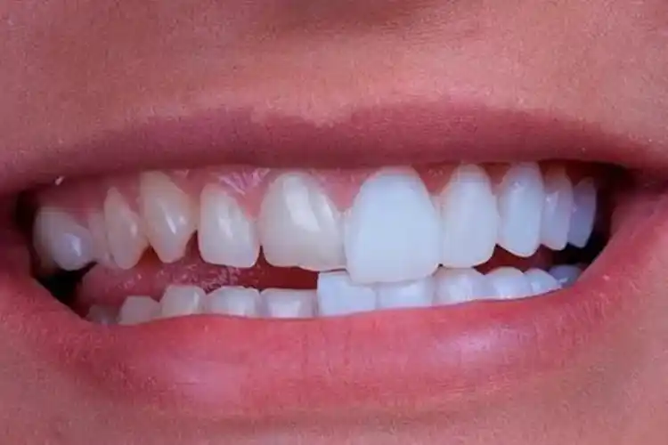 Facetas de Resina