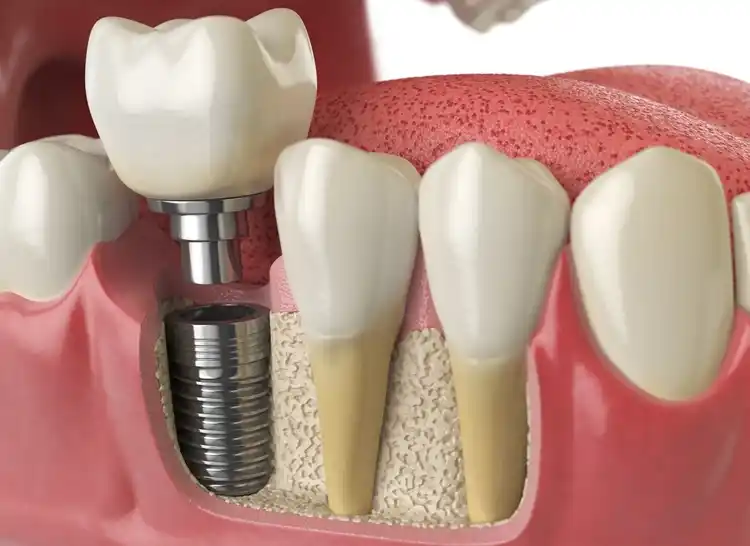 Implante Dental