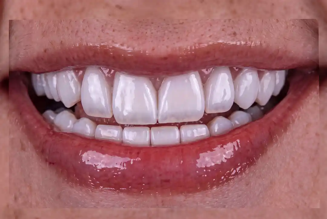 Sorriso Depois