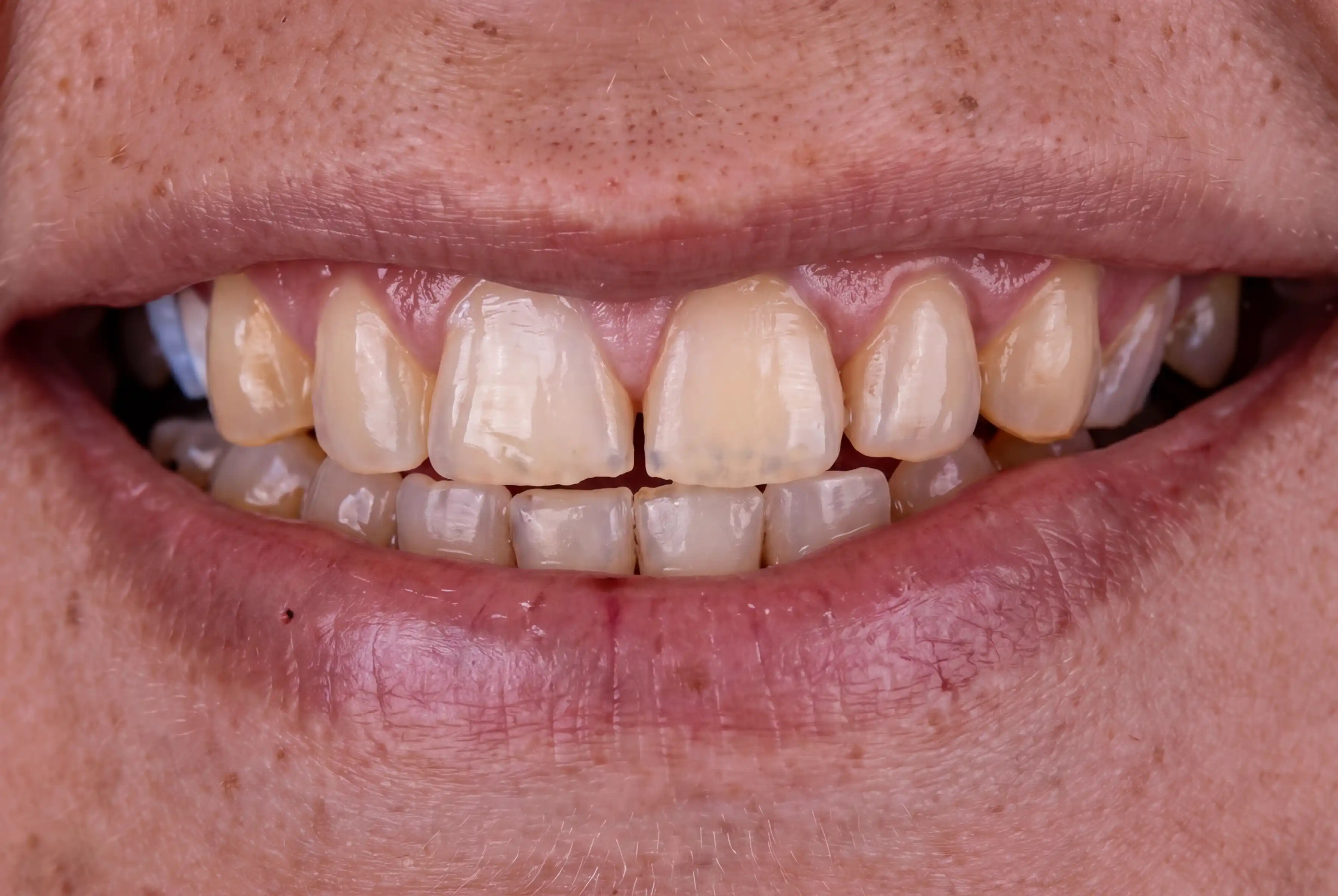 Sorriso Antes